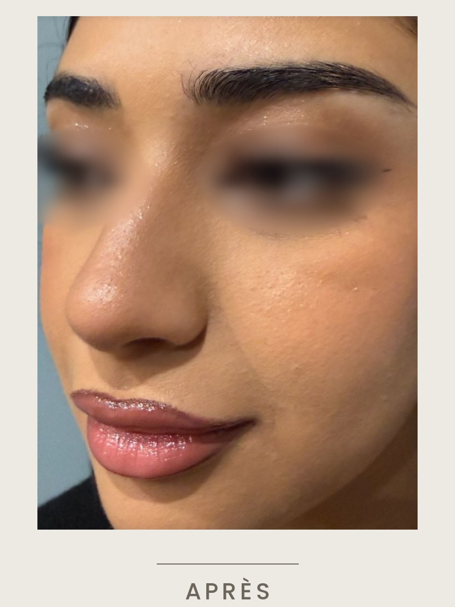 Botox du nez, vue de trois quarts après traitement