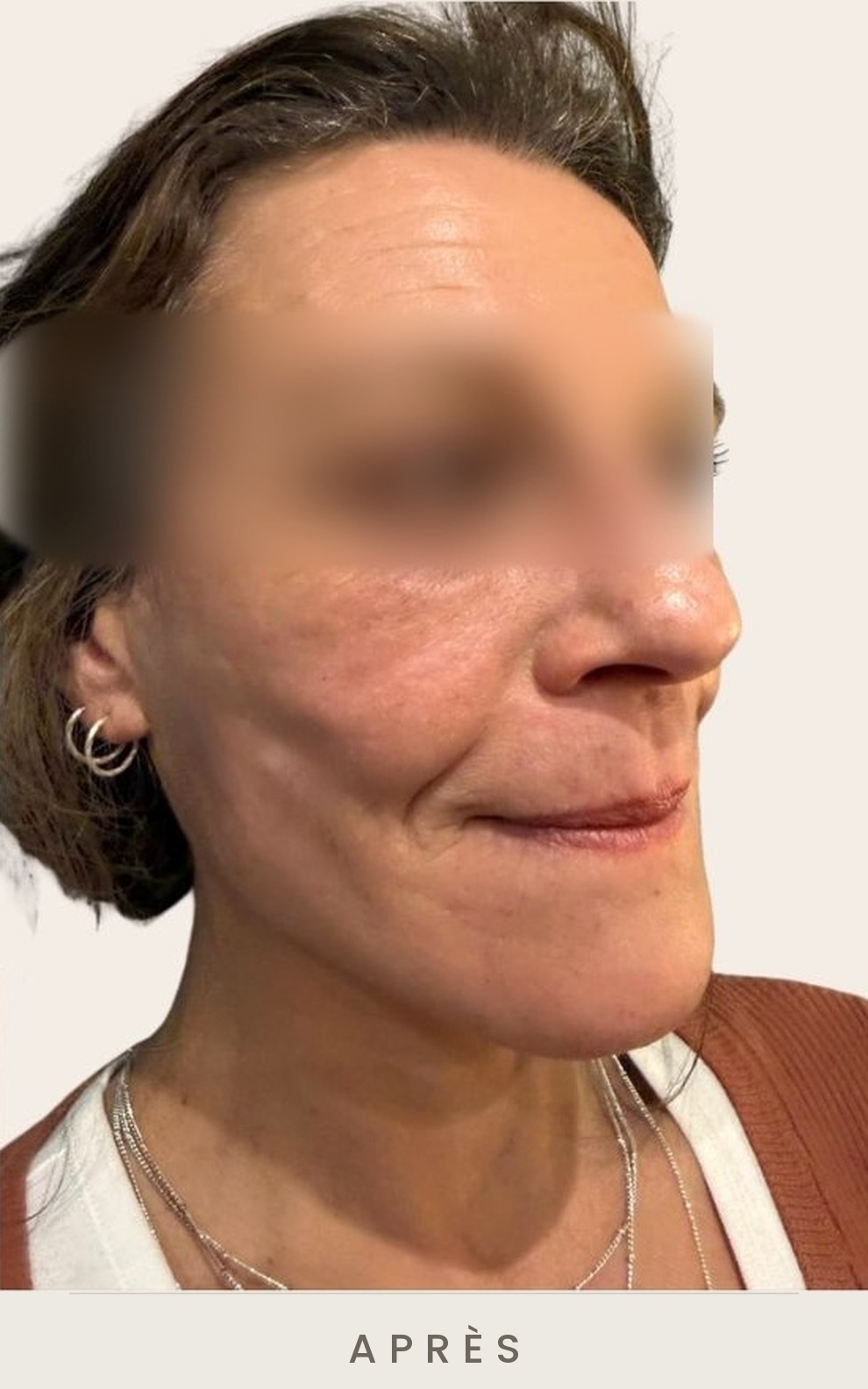 Lifting cervico-facial et lipofilling de la vallée des larmes, trois quarts droit après l'intervention — Dr David Ganon, chirurgien plasticien à Paris