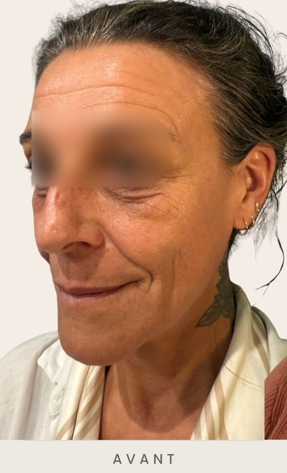 Lifting cervico-facial et lipofilling de la vallée des larmes, trois quarts gauche avant l'intervention — Dr David Ganon, chirurgien plasticien à Paris