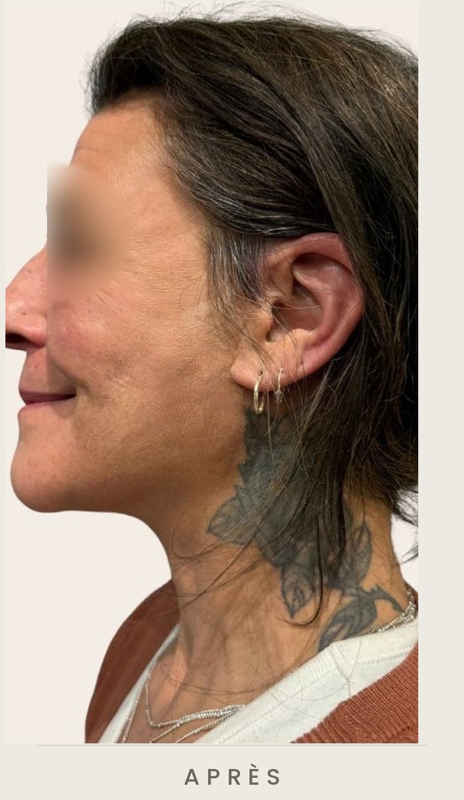 Lifting cervico-facial et lipofilling de la vallée des larmes, profil après l'intervention — Dr David Ganon, chirurgien plasticien à Paris