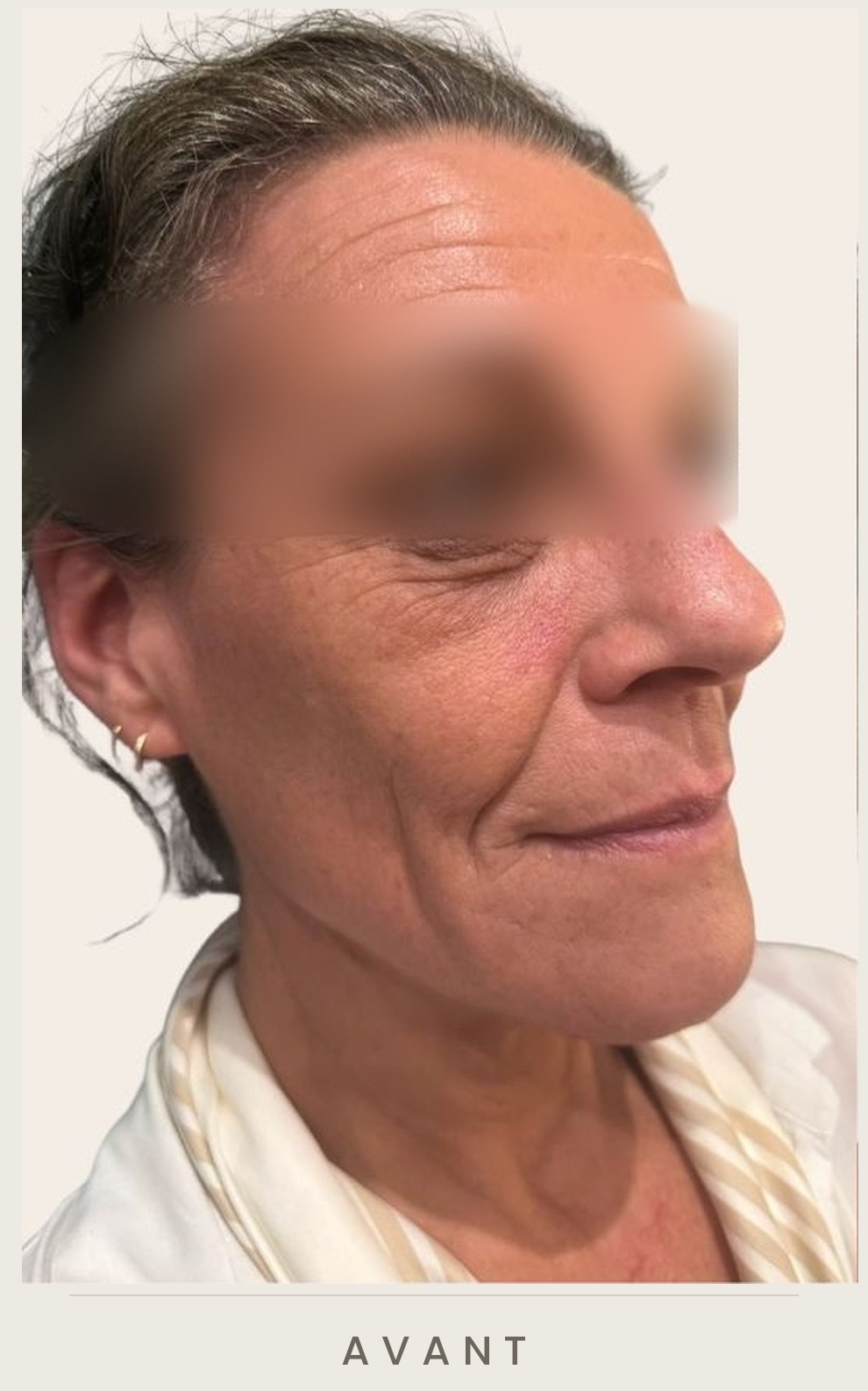 Lifting cervico-facial et lipofilling de la vallée des larmes, trois quarts droit avant l'intervention — Dr David Ganon, chirurgien plasticien à Paris