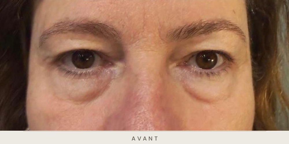 Blépharoplastie quatre paupières, vue de face avant l'intervention — Dr David Ganon, chirurgien plasticien à Paris
