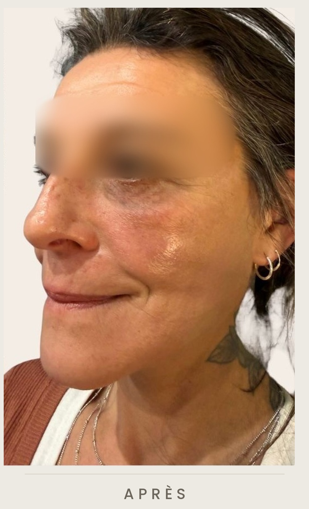 Lifting cervico-facial et lipofilling de la vallée des larmes, trois quarts gauche après l'intervention — Dr David Ganon, chirurgien plasticien à Paris