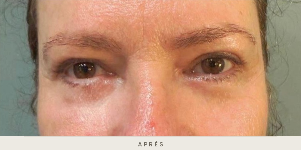 Blépharoplastie quatre paupières, vue de face après l'intervention — Dr David Ganon, chirurgien plasticien à Paris