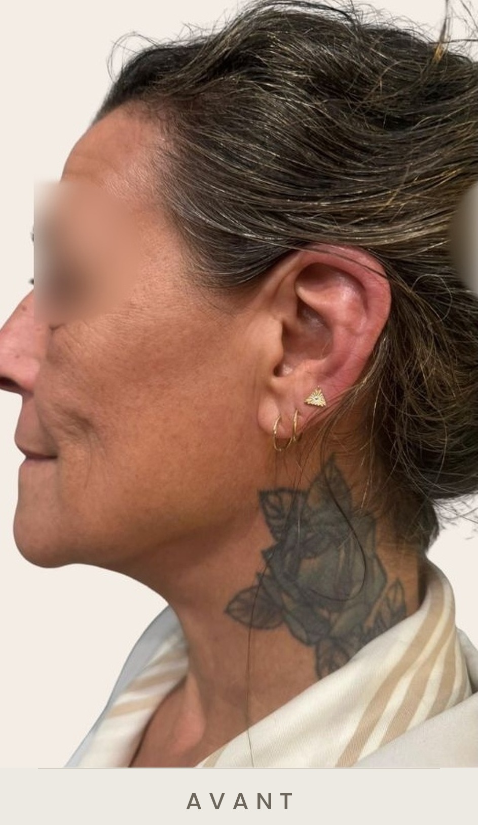 Lifting cervico-facial et lipofilling de la vallée des larmes, profil avant l'intervention — Dr David Ganon, chirurgien plasticien à Paris