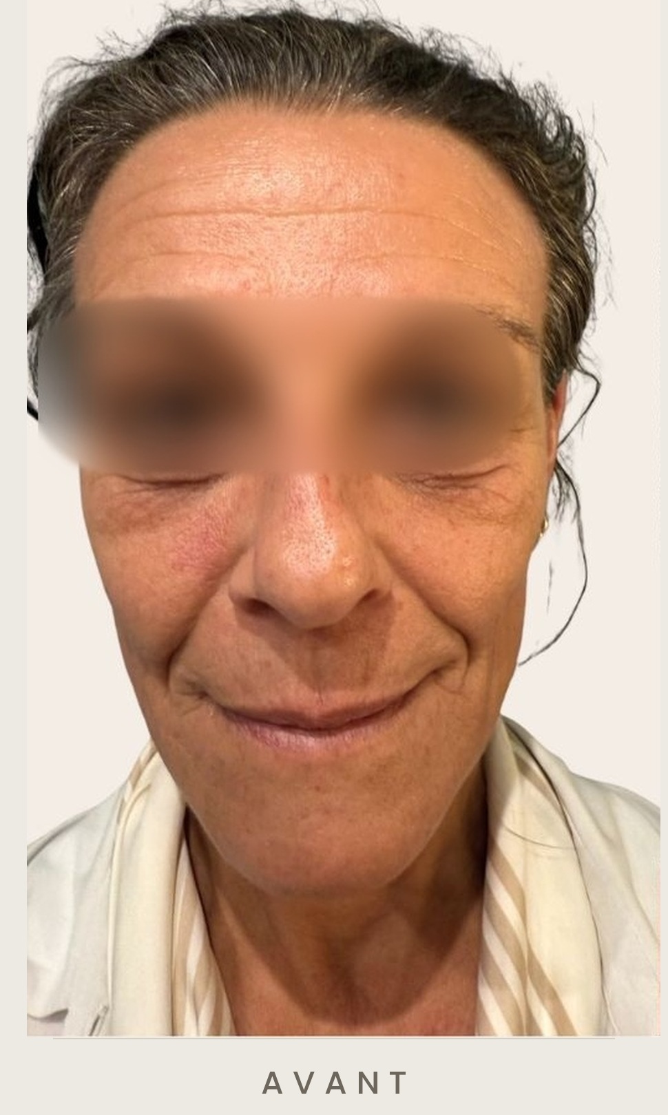 Lifting cervico-facial et lipofilling de la vallée des larmes, vue de face avant l'intervention — Dr David Ganon, chirurgien plasticien à Paris
