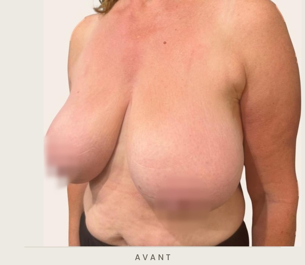 Réduction mammaire, trois quarts gauche avant l'intervention — Dr David Ganon, chirurgien plasticien à Paris