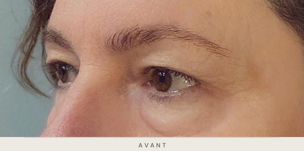 Blépharoplastie quatre paupières, vue de trois quarts avant l'intervention — Dr David Ganon, chirurgien plasticien à Paris