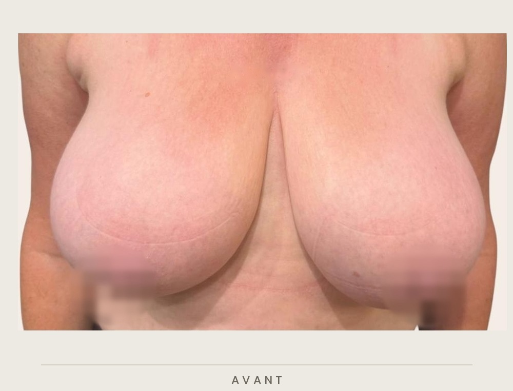 Réduction mammaire, vue de face avant l'intervention — Dr David Ganon, chirurgien plasticien à Paris
