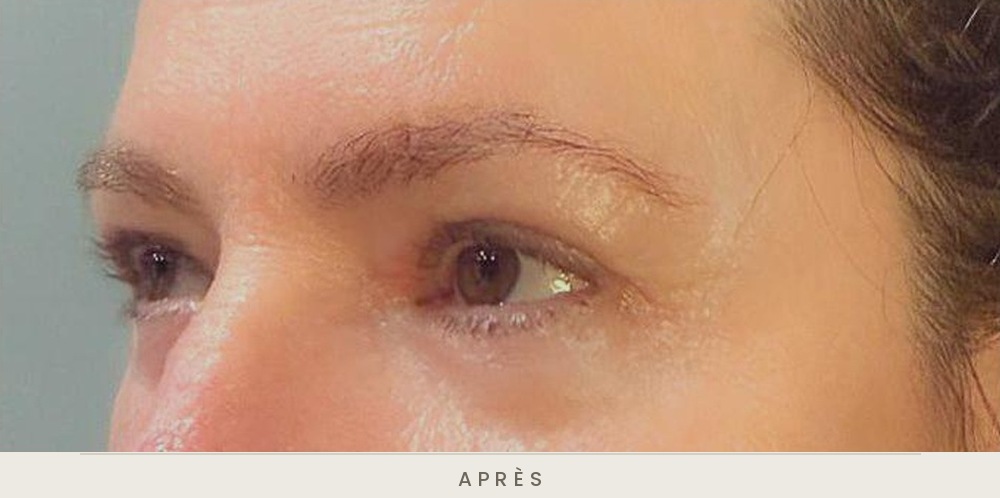 Blépharoplastie quatre paupières, vue de trois quarts après l'intervention — Dr David Ganon, chirurgien plasticien à Paris
