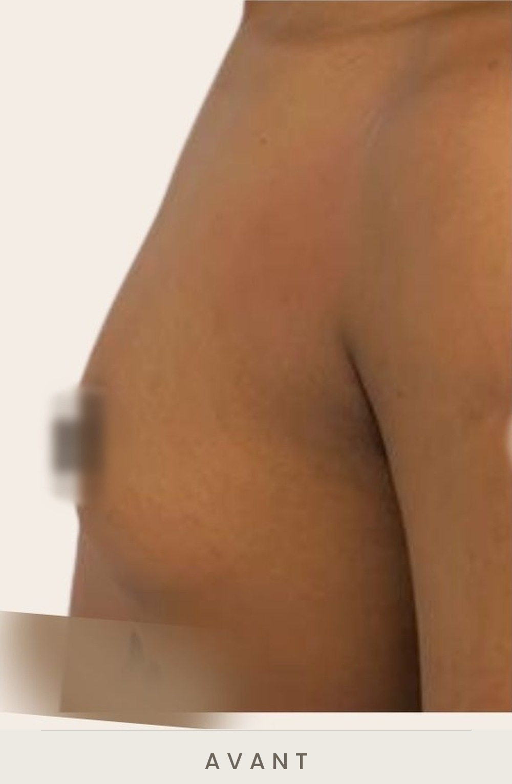 Augmentation mammaire par prothèses, profil gauche avant l'intervention — Dr David Ganon, chirurgien plasticien à Paris
