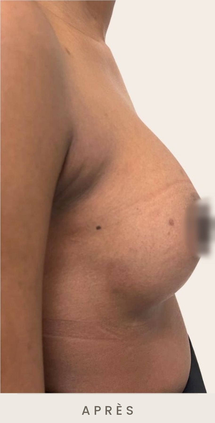 Augmentation mammaire par prothèses, profil droit après l'intervention — Dr David Ganon, chirurgien plasticien à Paris