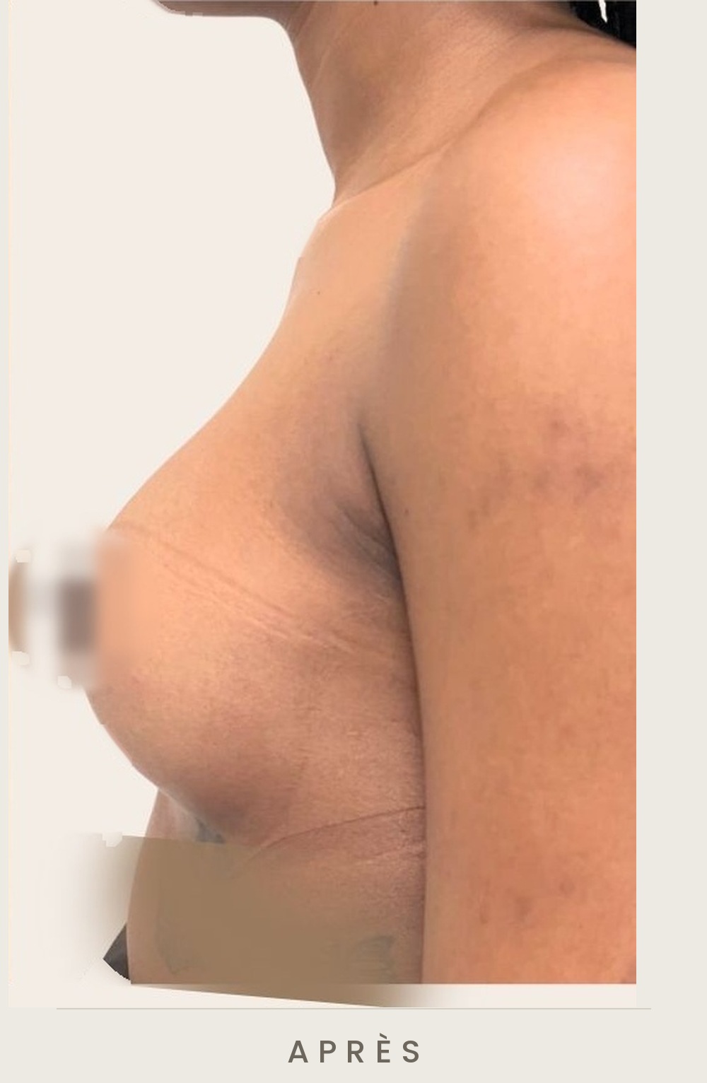 Augmentation mammaire par prothèses, profil gauche après l'intervention — Dr David Ganon, chirurgien plasticien à Paris