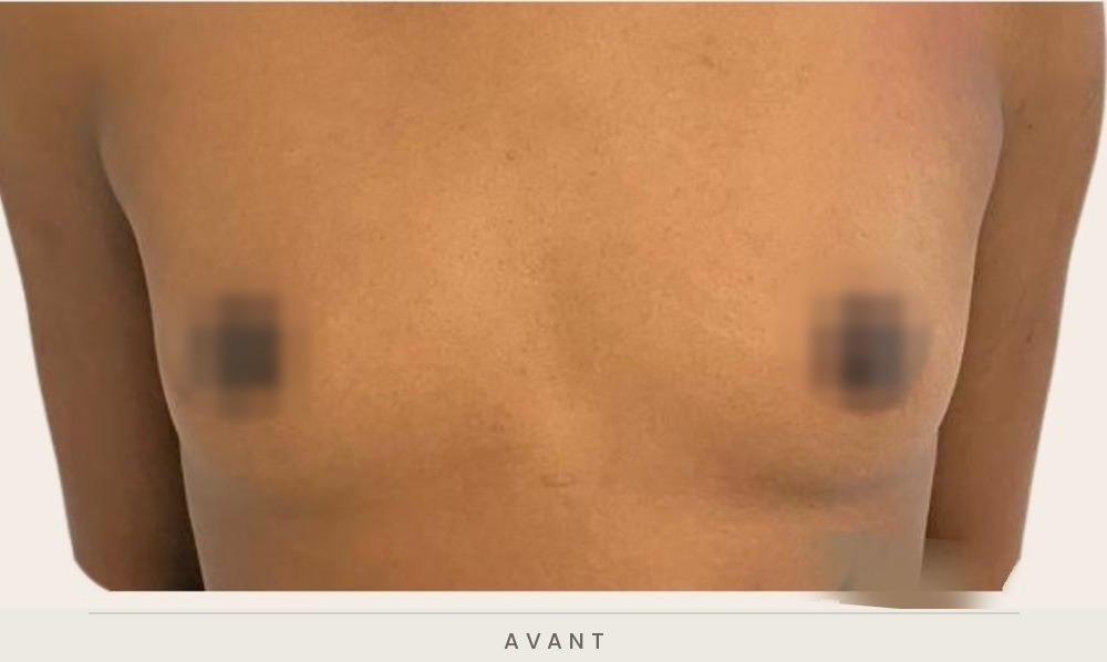 Augmentation mammaire par prothèses, vue de face avant l'intervention — Dr David Ganon, chirurgien plasticien à Paris