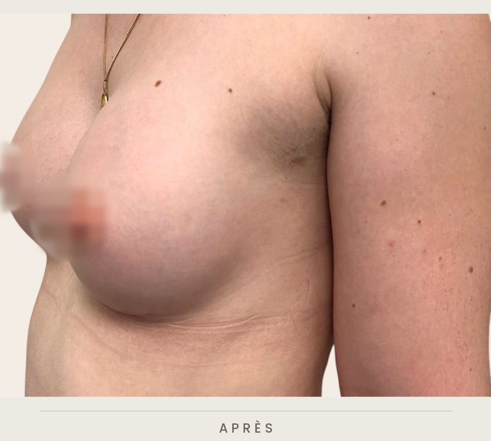 Augmentation mammaire par prothèses, trois quarts gauche après l'intervention — Dr David Ganon, chirurgien plasticien à Paris