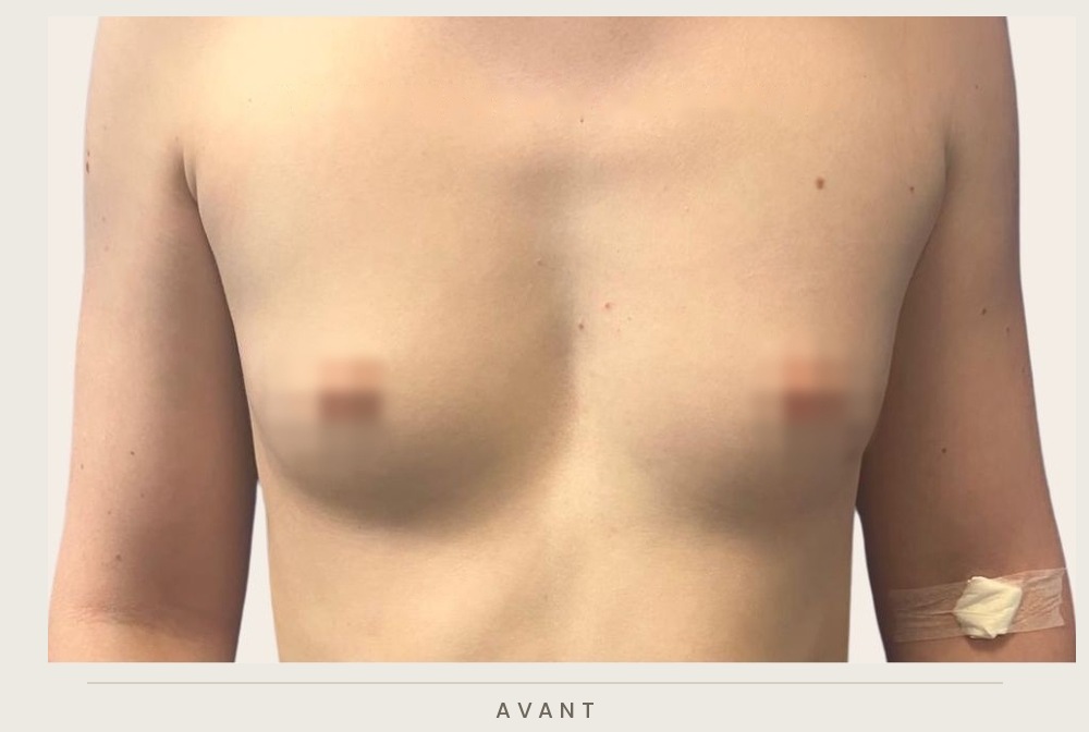 Augmentation mammaire par prothèses, vue de face avant l'intervention — Dr David Ganon, chirurgien plasticien à Paris