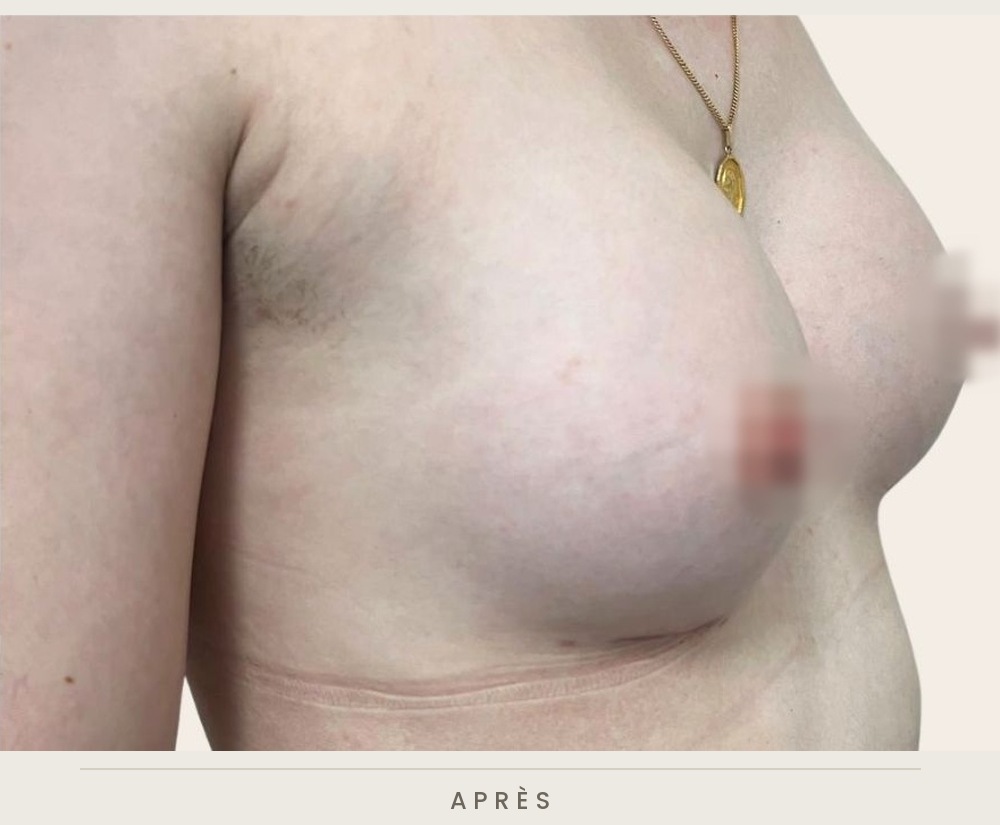 Augmentation mammaire par prothèses, trois quarts droit après l'intervention — Dr David Ganon, chirurgien plasticien à Paris
