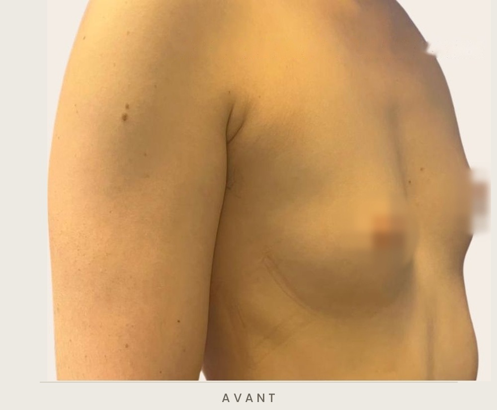 Augmentation mammaire par prothèses, trois quarts droit avant l'intervention — Dr David Ganon, chirurgien plasticien à Paris
