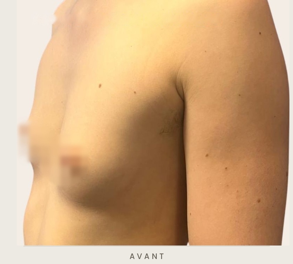 Augmentation mammaire par prothèses, trois quarts gauche avant l'intervention — Dr David Ganon, chirurgien plasticien à Paris