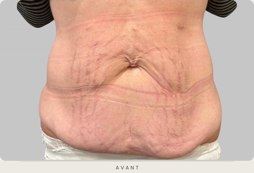 Plastie abdominale, vue de face avant l'intervention — Dr David Ganon, chirurgien plasticien à Paris