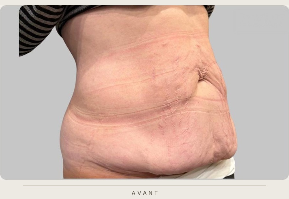 Abdominoplastie (plastie abdominale), trois quarts droit avant l'intervention — Dr David Ganon, chirurgien plasticien à Paris