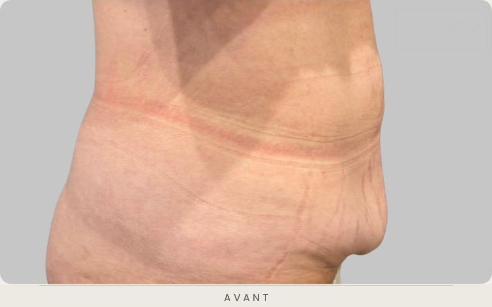 Abdominoplastie (plastie abdominale), profil gauche avant l'intervention — Dr David Ganon, chirurgien plasticien à Paris
