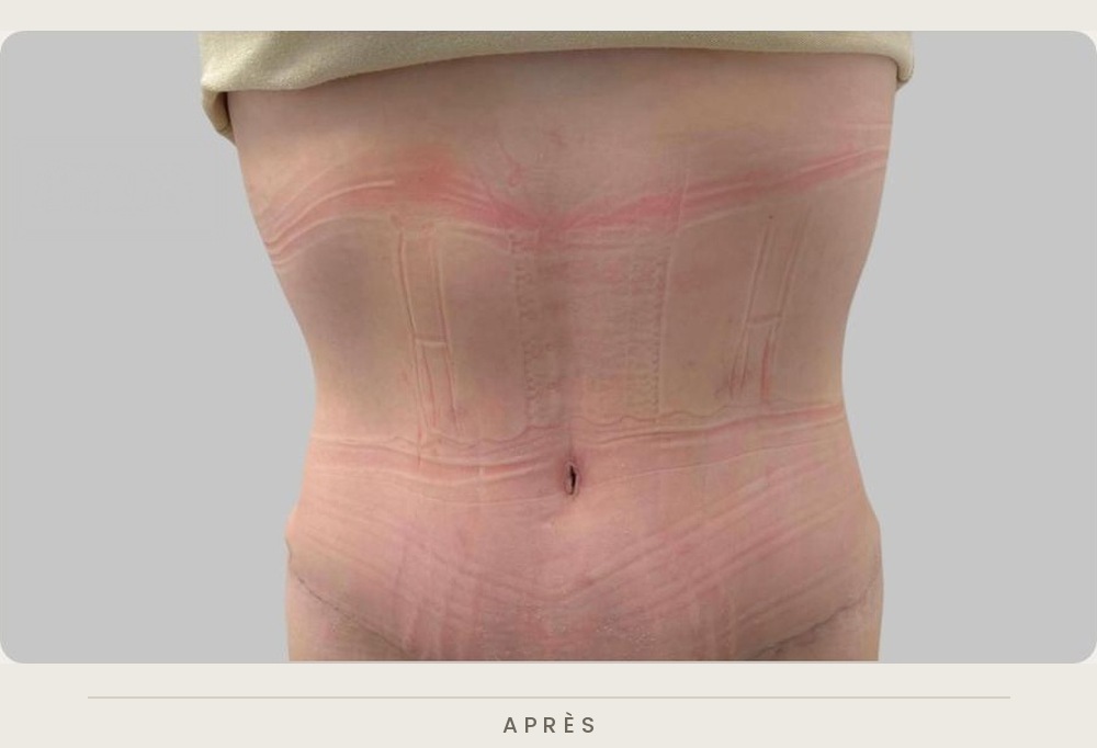 Plastie abdominale, vue de face un mois après l'intervention — Dr David Ganon, chirurgien plasticien à Paris