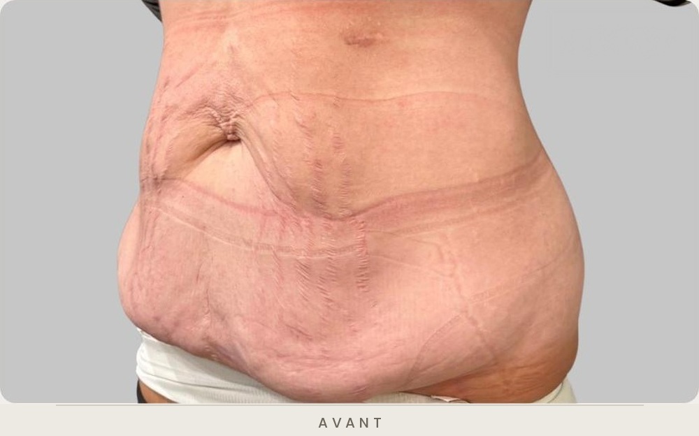 Abdominoplastie (plastie abdominale), trois quarts gauche avant l'intervention — Dr David Ganon, chirurgien plasticien à Paris