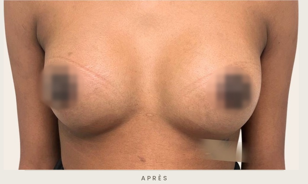 Augmentation mammaire par prothèses, vue de face après l'intervention — Dr David Ganon, chirurgien plasticien à Paris