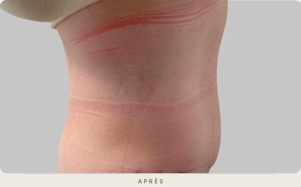 Abdominoplastie (plastie abdominale), profil gauche un mois après l'intervention — Dr David Ganon, chirurgien plasticien à Paris