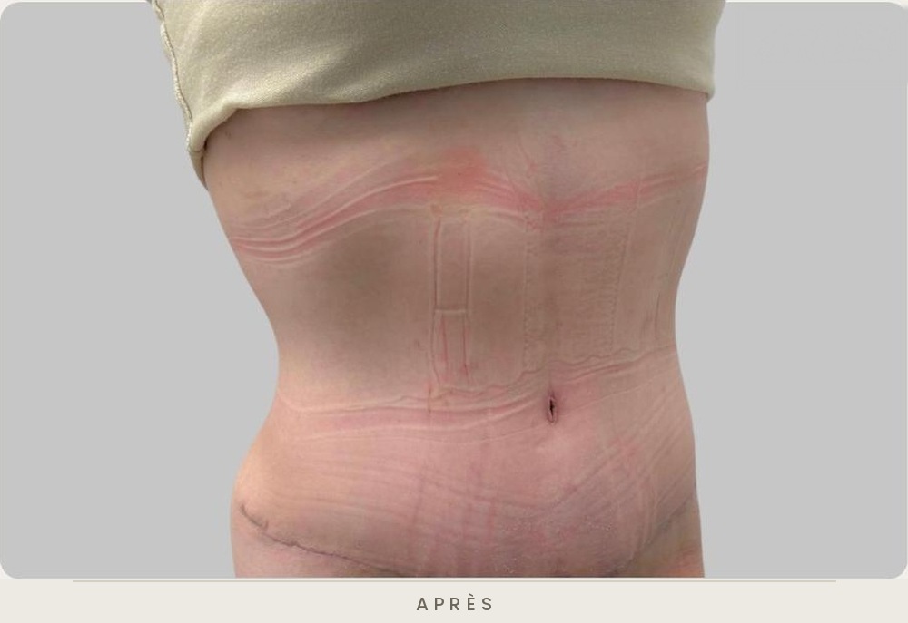 Abdominoplastie (plastie abdominale), trois quarts droit un mois après l'intervention — Dr David Ganon, chirurgien plasticien à Paris