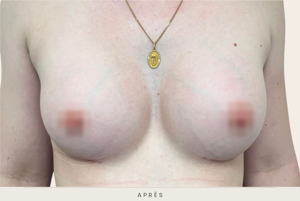 Augmentation mammaire par prothèses, vue de face après l'intervention — Dr David Ganon, chirurgien plasticien à Paris