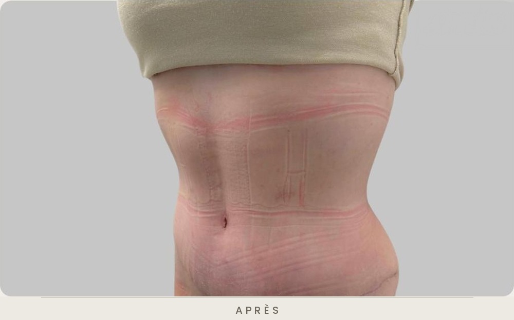 Abdominoplastie (plastie abdominale), trois quarts gauche un mois après l'intervention — Dr David Ganon, chirurgien plasticien à Paris