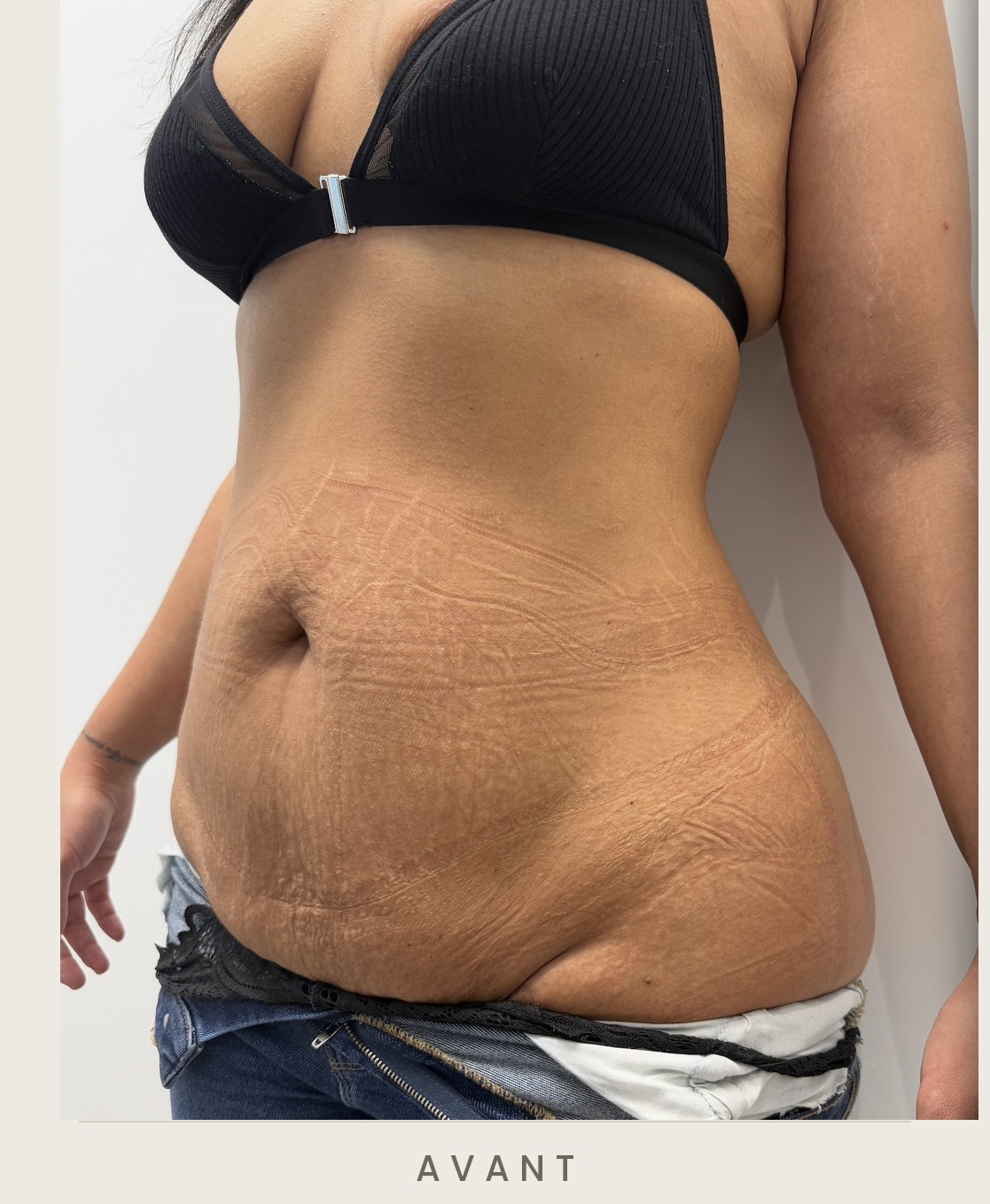 Abdominoplastie (plastie abdominale), trois quarts gauche avant l'intervention — Dr David Ganon, chirurgien plasticien à Paris