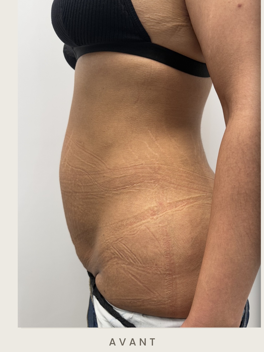 Abdominoplastie (plastie abdominale), profil gauche avant l'intervention — Dr David Ganon, chirurgien plasticien à Paris