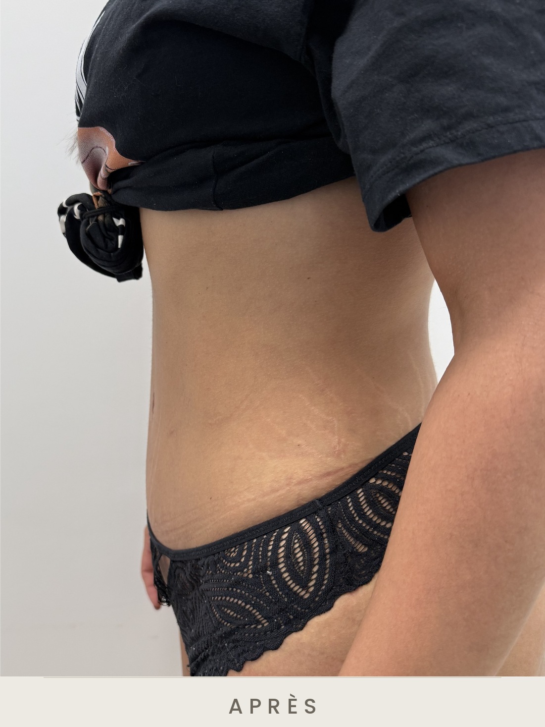 Abdominoplastie (plastie abdominale), profil gauche après l'intervention — Dr David Ganon, chirurgien plasticien à Paris