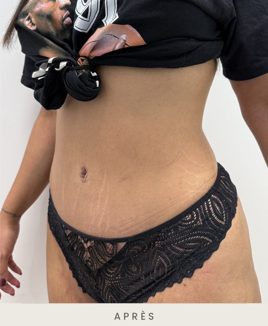 Abdominoplastie (plastie abdominale), trois quarts gauche après l'intervention — Dr David Ganon, chirurgien plasticien à Paris