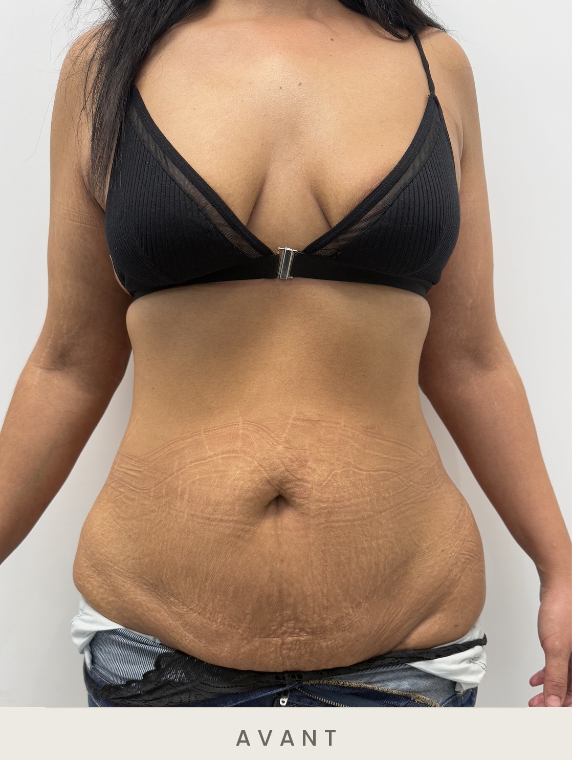 Abdominoplastie (plastie abdominale), vue de face avant l'intervention — Dr David Ganon, chirurgien plasticien à Paris