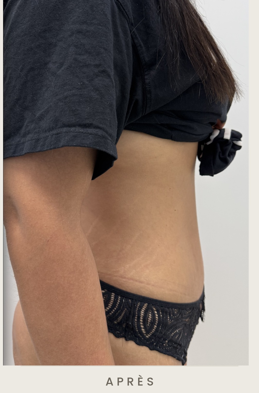 Abdominoplastie (plastie abdominale), profil droit après l'intervention — Dr David Ganon, chirurgien plasticien à Paris