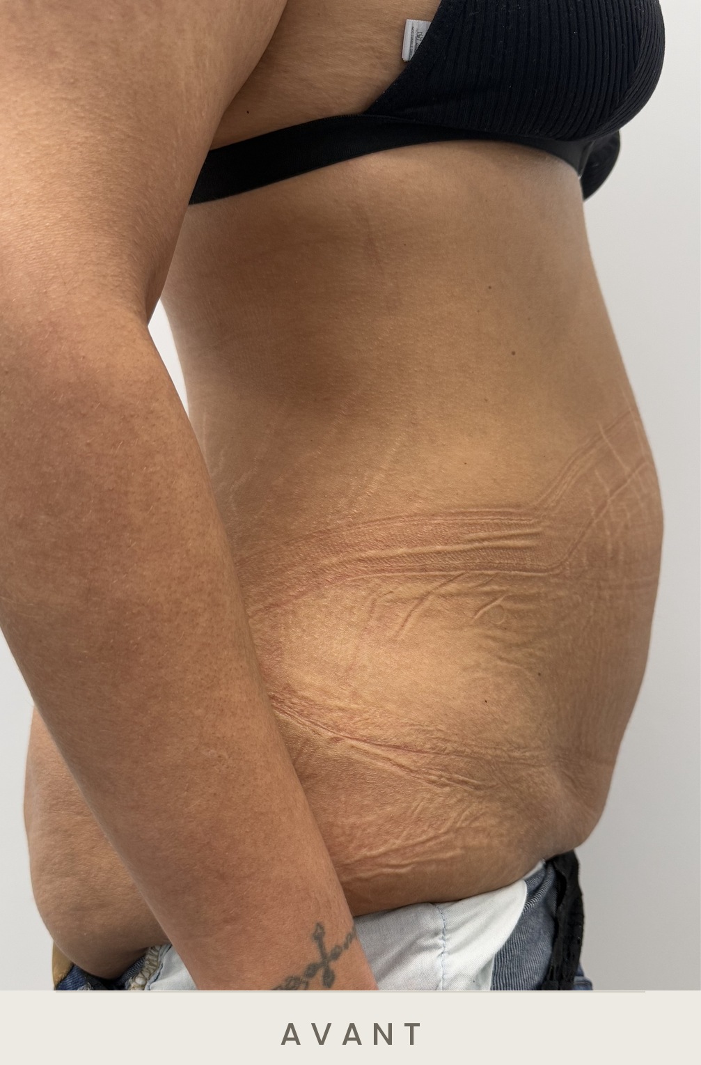 Abdominoplastie (plastie abdominale), profil droit avant l'intervention — Dr David Ganon, chirurgien plasticien à Paris