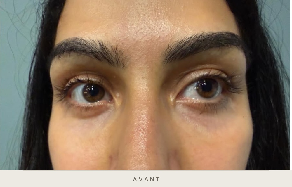 Traitement des cernes à l'acide hyaluronique, vue de face avant l'injection — Dr David Ganon, chirurgien plasticien à Paris