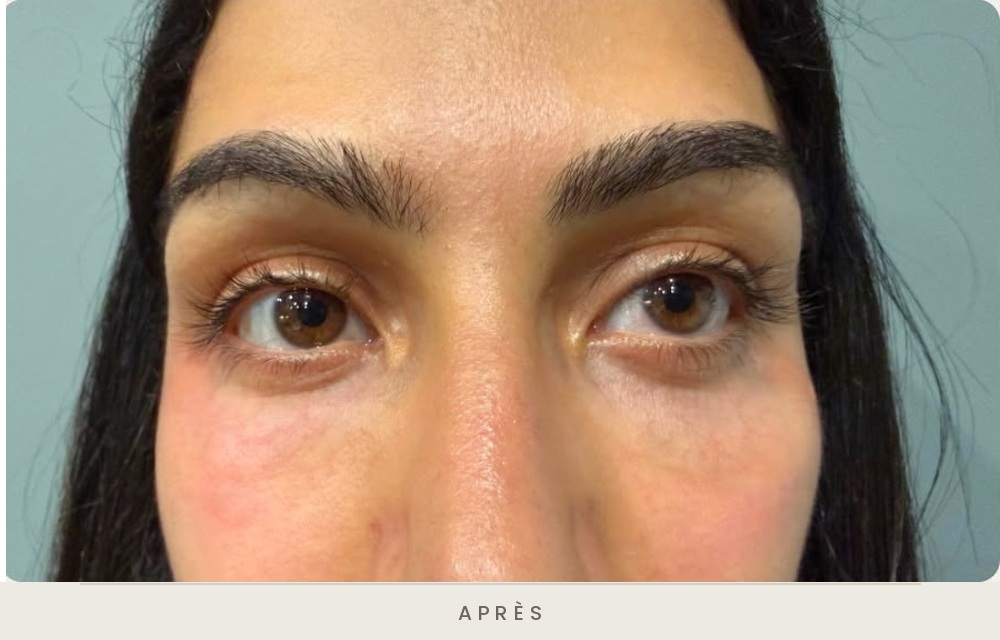Traitement des cernes à l'acide hyaluronique, vue de face après l'injection — Dr David Ganon, chirurgien plasticien à Paris