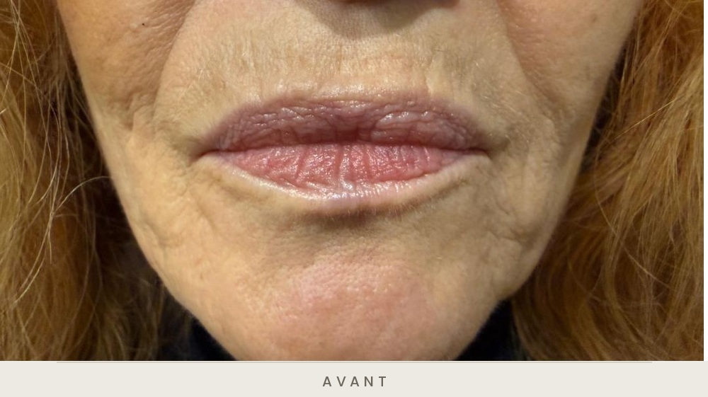 Injection des lèvres à l'acide hyaluronique, vue de face, technique blanching avant l'injection — Dr David Ganon, chirurgien plasticien à Paris