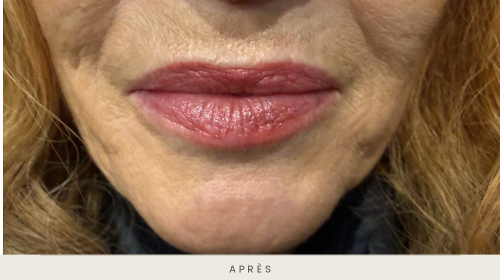 Injection des lèvres à l'acide hyaluronique, vue de face, technique blanching après l'injection — Dr David Ganon, chirurgien plasticien à Paris