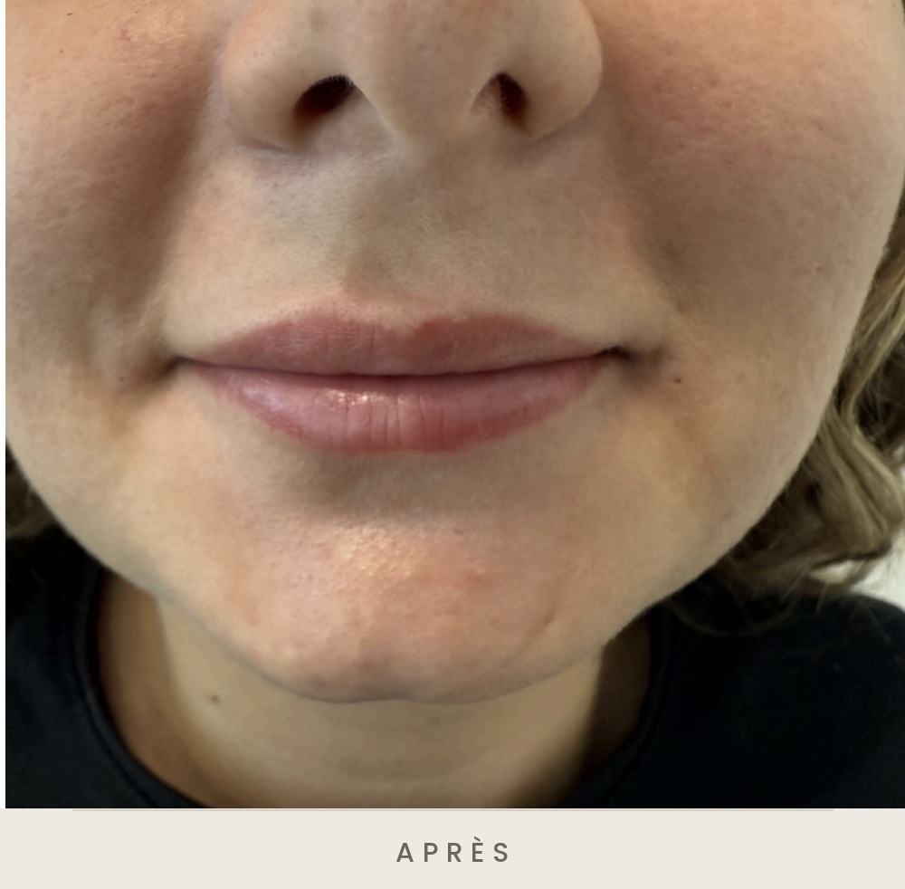 Injection des lèvres à l'acide hyaluronique, vue de face après l'injection — Dr David Ganon, chirurgien plasticien à Paris