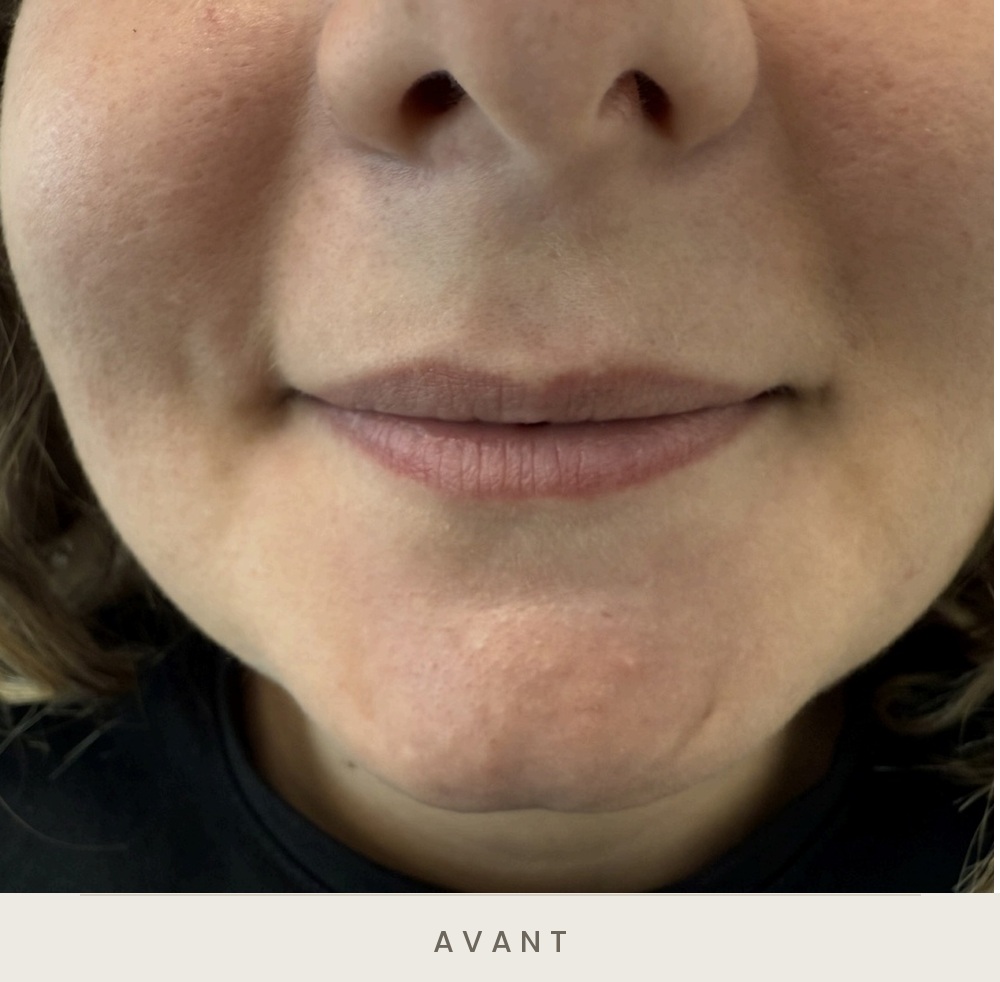 Injection des lèvres à l'acide hyaluronique, vue de face avant l'injection — Dr David Ganon, chirurgien plasticien à Paris