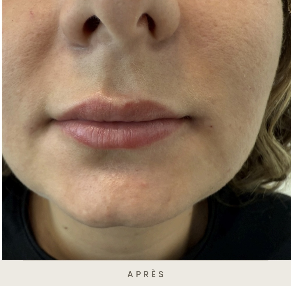 Injection des lèvres à l'acide hyaluronique, vue de face après l'injection — Dr David Ganon, chirurgien plasticien à Paris