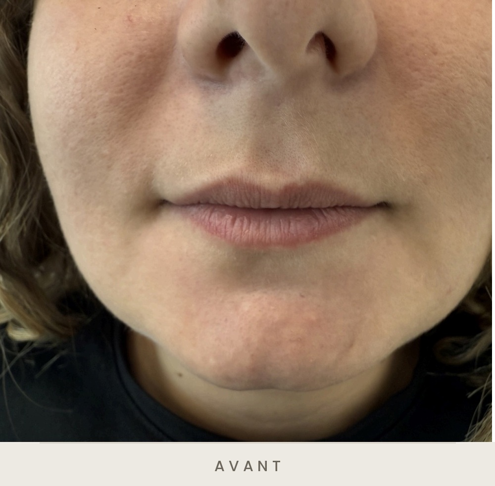 Injection des lèvres à l'acide hyaluronique, vue de face avant l'injection — Dr David Ganon, chirurgien plasticien à Paris