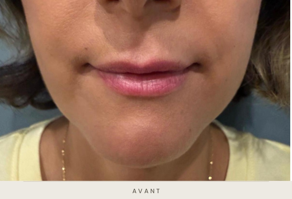 Injection des lèvres à l'acide hyaluronique, vue de face avant l'injection — Dr David Ganon, chirurgien plasticien à Paris