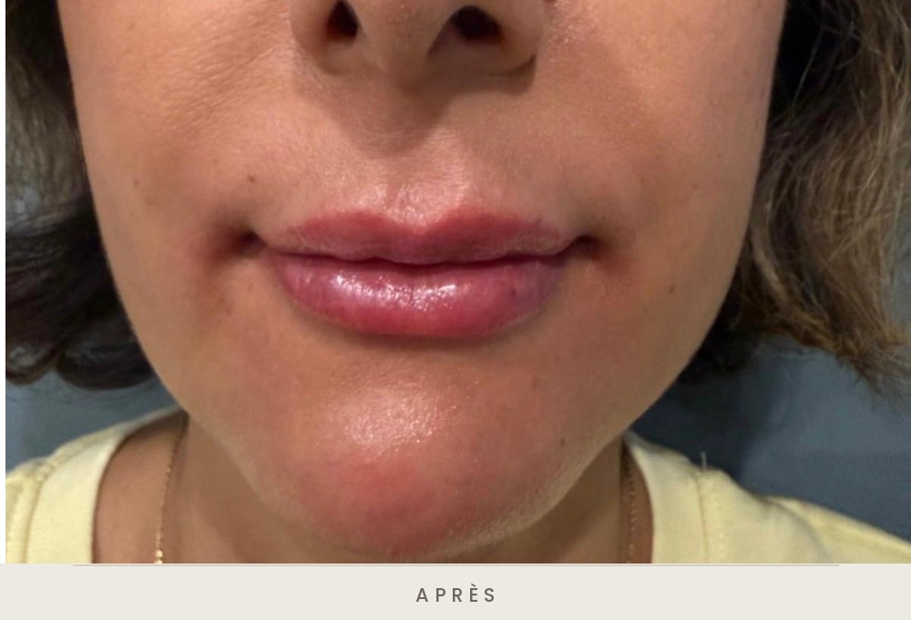 Injection des lèvres à l'acide hyaluronique, vue de face après l'injection — Dr David Ganon, chirurgien plasticien à Paris